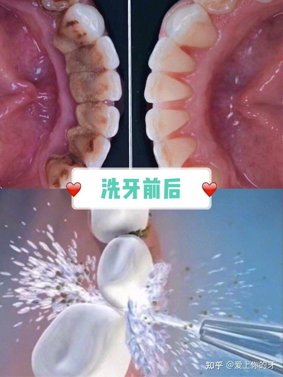 松原洗牙可以用医保吗(洗牙可以用医保吗,报销比例多少)